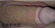 重庆曙光包皮手术