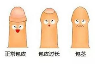 重庆结婚要割包皮吗