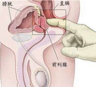 重庆前列腺增生用药